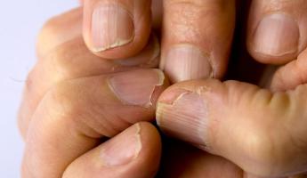 Ломаются ногти на руках или ногах — причины и как укрепить препаратами, питанием и народными средствами